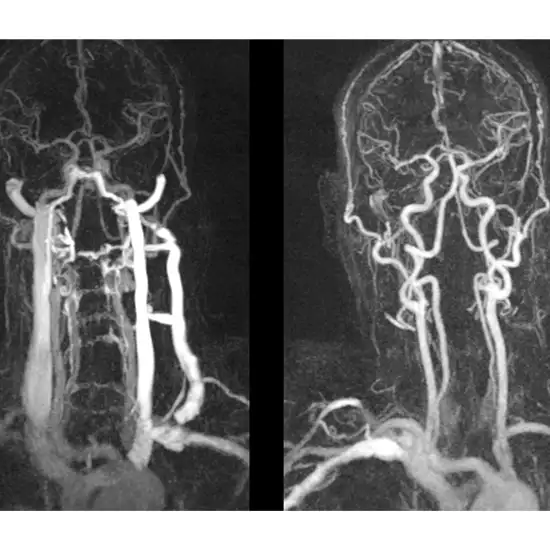CT Neck Angiography